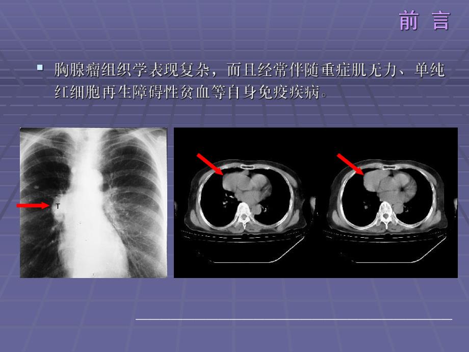 110例胸腺瘤WHO分型及Masaoka分期的回顾研究宋楠.ppt_第3页