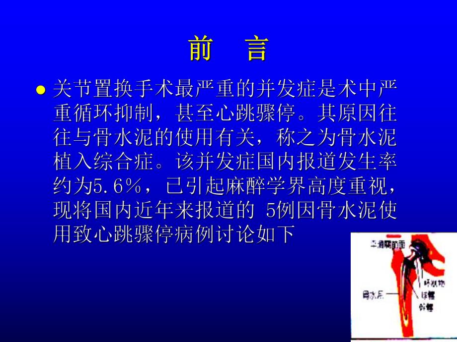 医学资料骨科手术中骨水泥毒性反应的预防.ppt_第2页