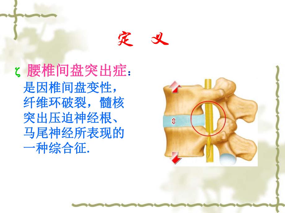 腰椎间盘突出症护理.ppt_第3页