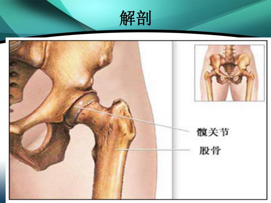 全髋关节置换健知识讲座.ppt_第3页