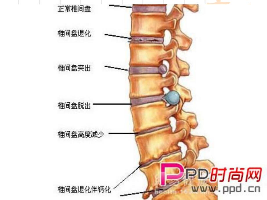 腰椎间盘突出症治疗方案.ppt_第3页