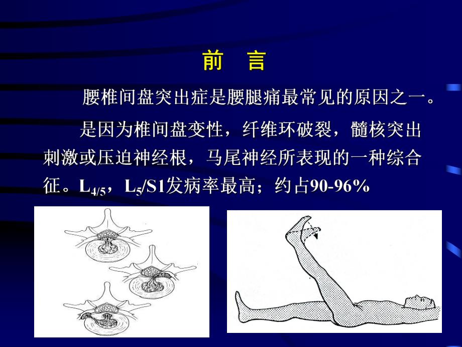 郭风劲——微创手术治疗腰椎间盘突出症.ppt_第2页