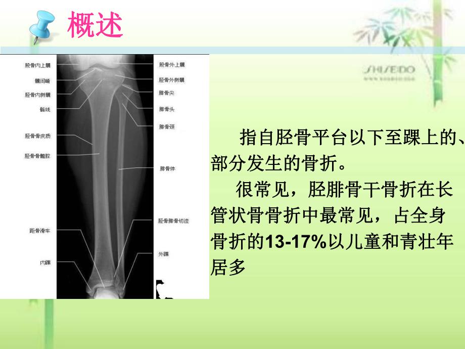 胫腓骨骨折的护理.ppt_第3页