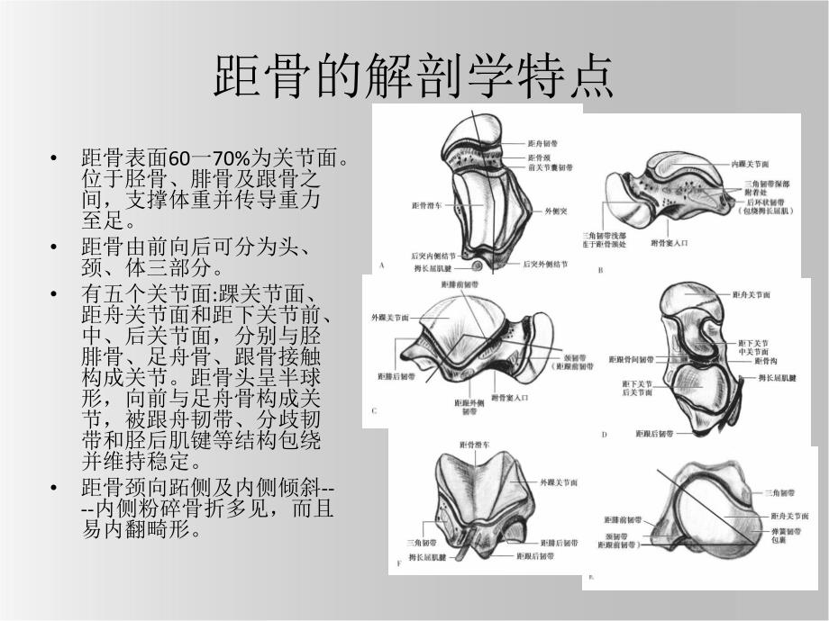 距骨骨折.ppt_第3页