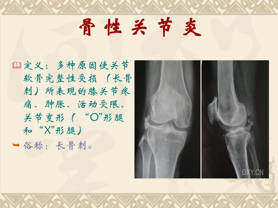 膝关节病健康教育.ppt_第2页