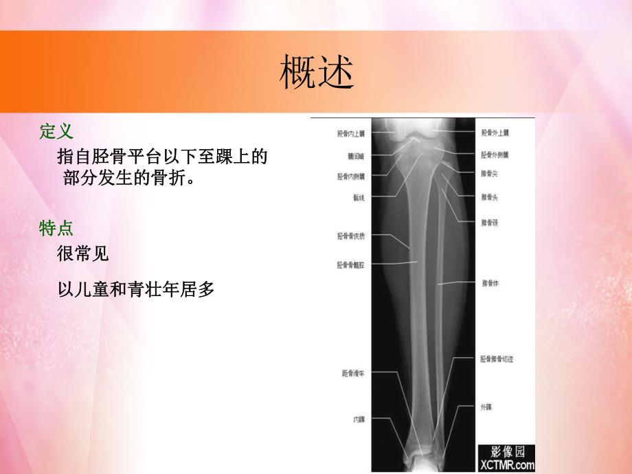 胫腓骨踝关节骨折专题培训PPT.ppt_第3页