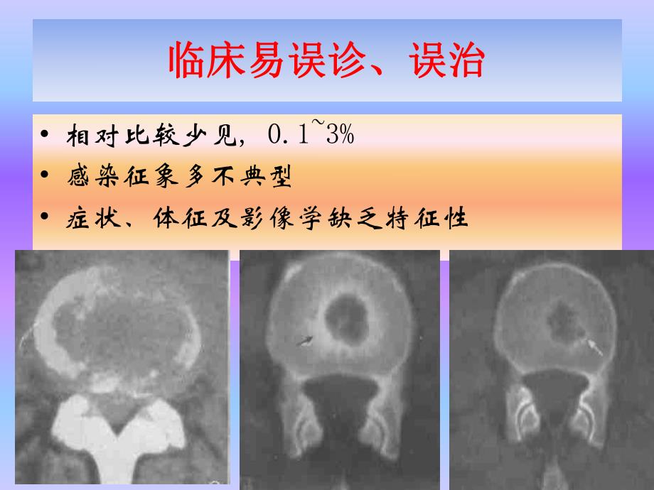 腰椎间隙感染的诊断和处理.ppt_第2页