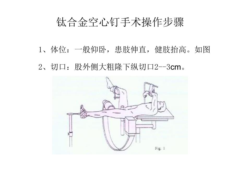 钛合金空心钉手术操作步骤.ppt_第1页