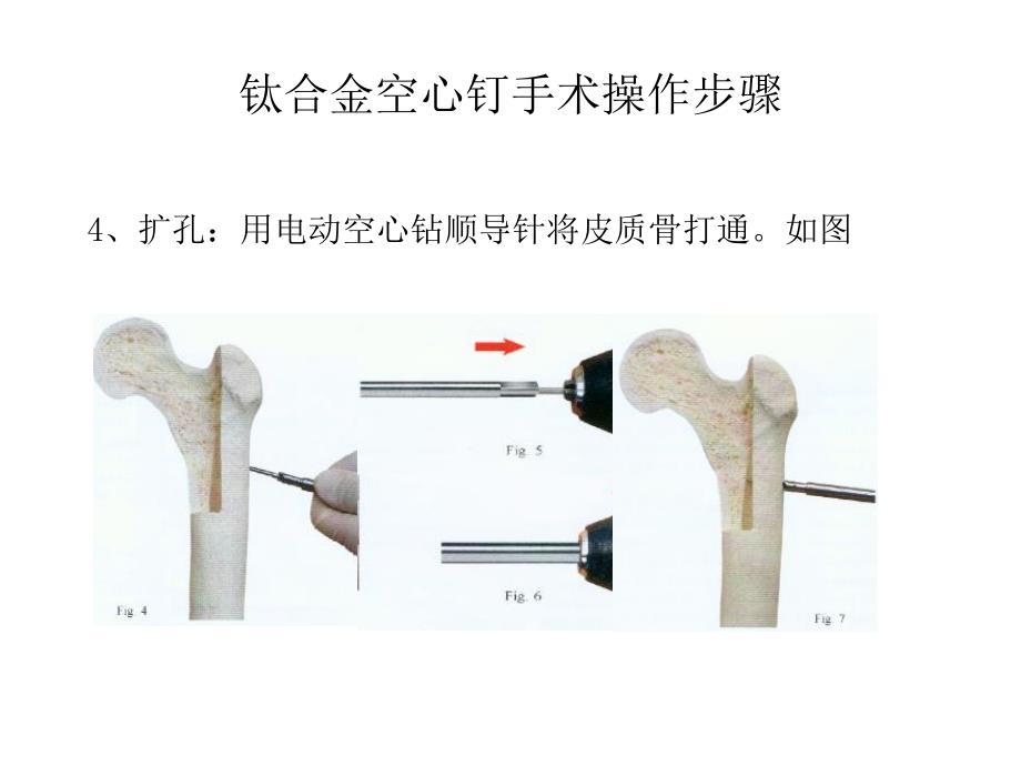 钛合金空心钉手术操作步骤.ppt_第3页