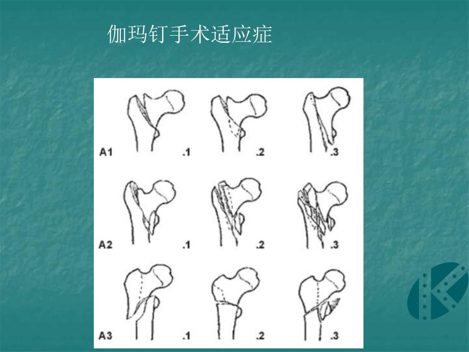 伽玛钉手术操作演示.ppt_第2页