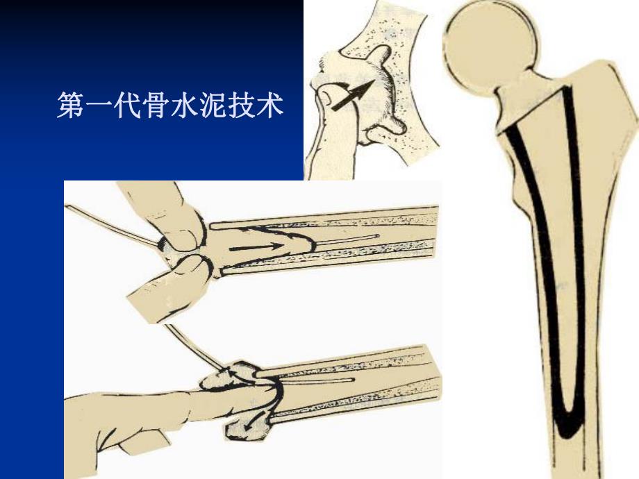 人工髋置换的骨水泥技术.ppt_第3页