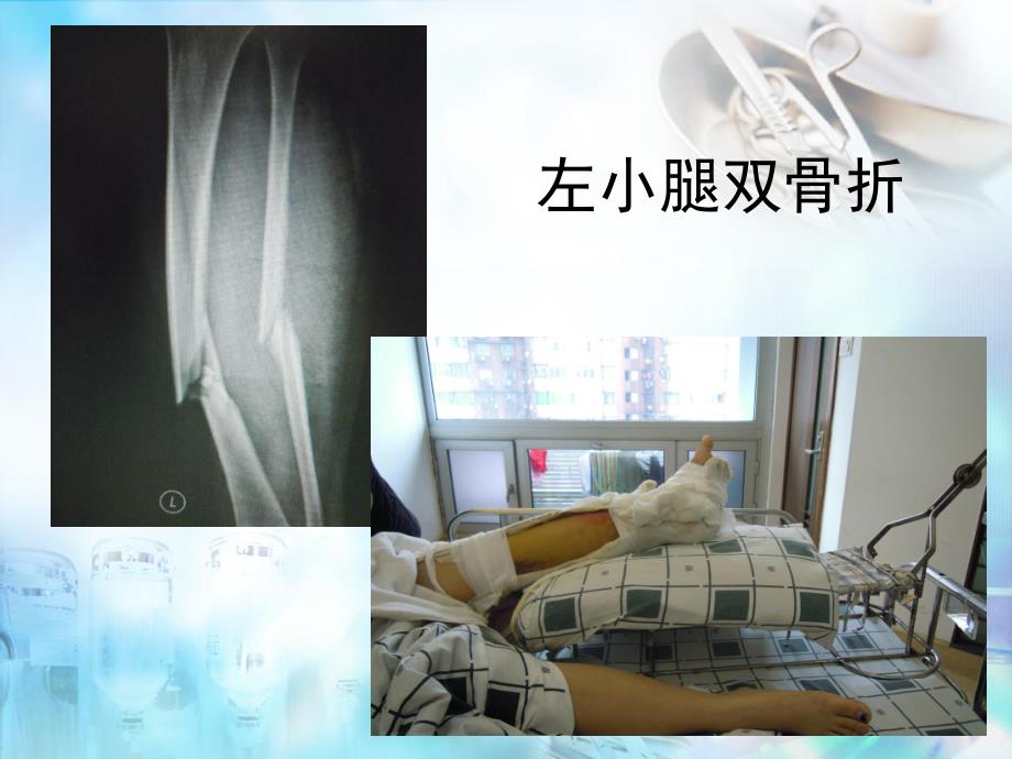 骨科病人护理翻身技巧.ppt_第2页