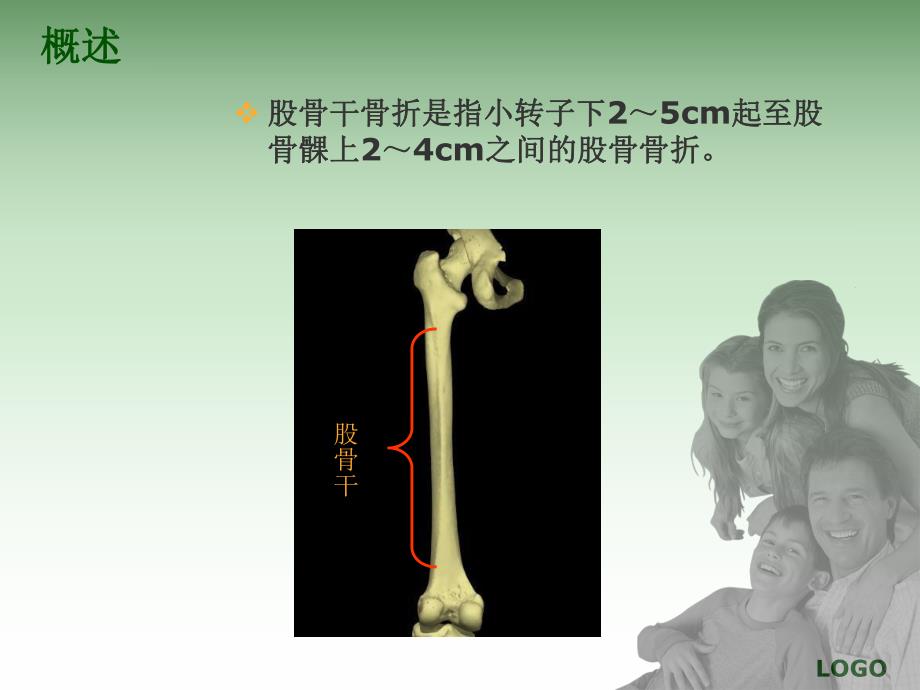 股骨干骨折的护理及功能锻炼.ppt_第2页