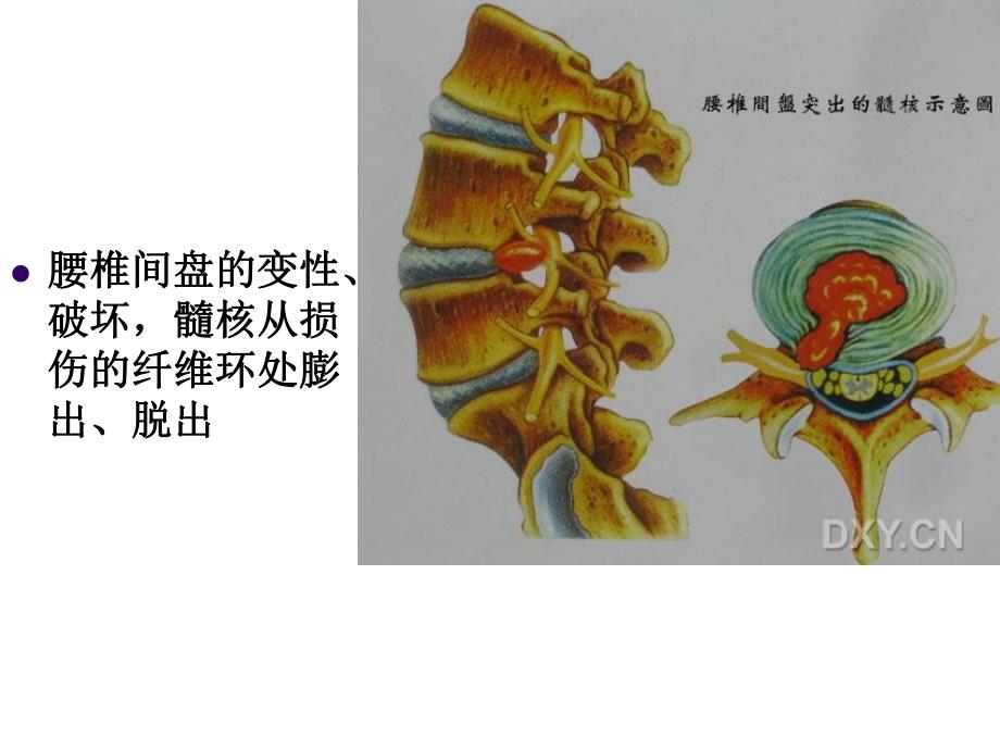 腰椎间盘突出症PPT幻灯片.ppt_第3页