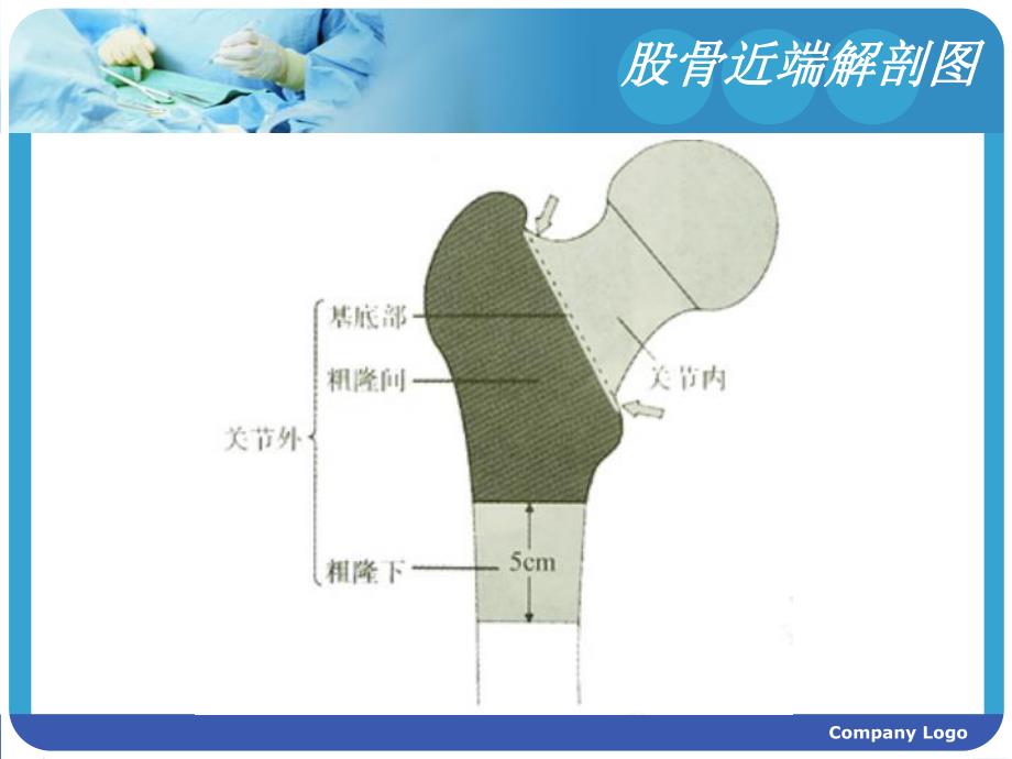 股骨粗隆间骨折相关知识.ppt_第3页