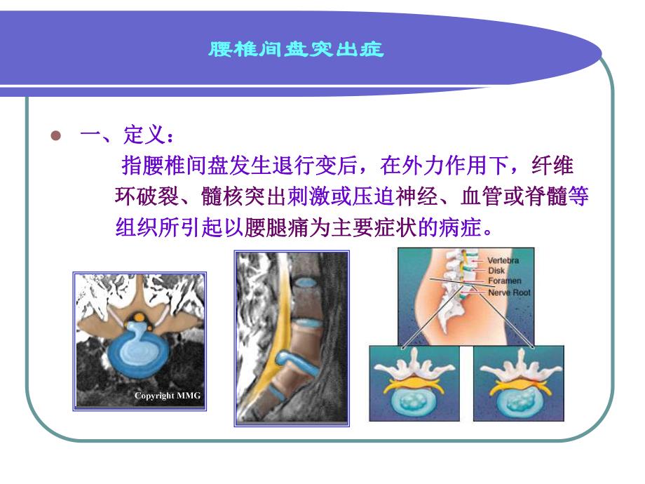 腰椎间盘突出症2.ppt_第2页