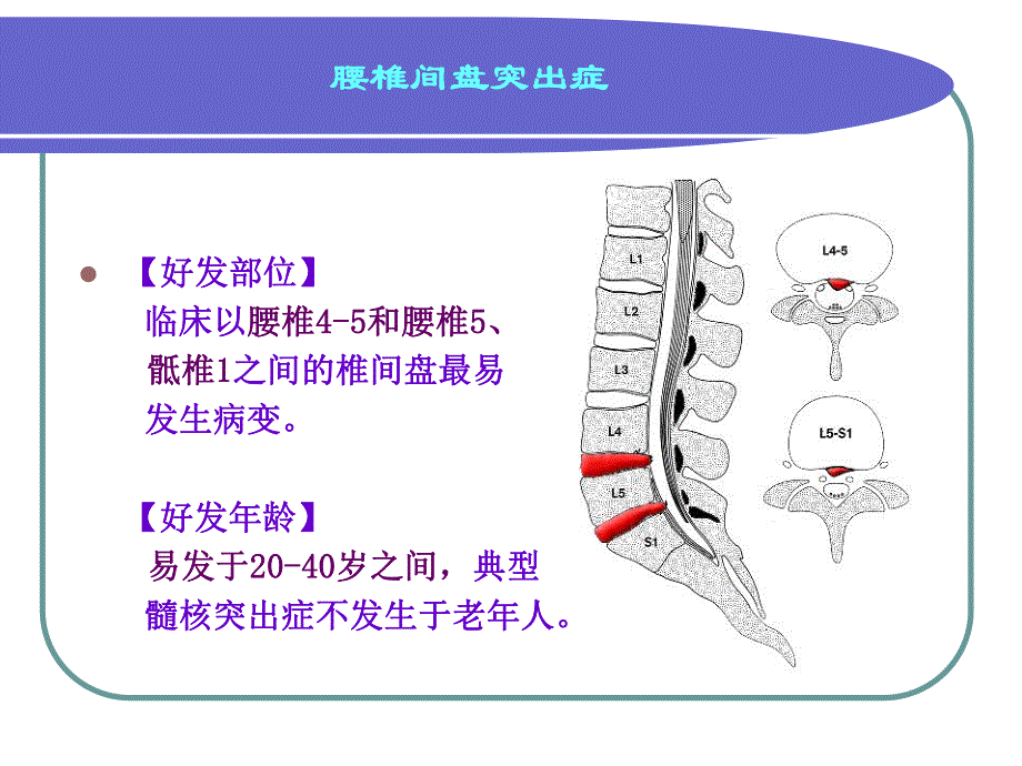 腰椎间盘突出症2.ppt_第3页