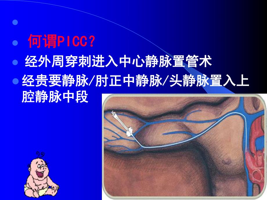 医院PICC临床运用.ppt_第3页