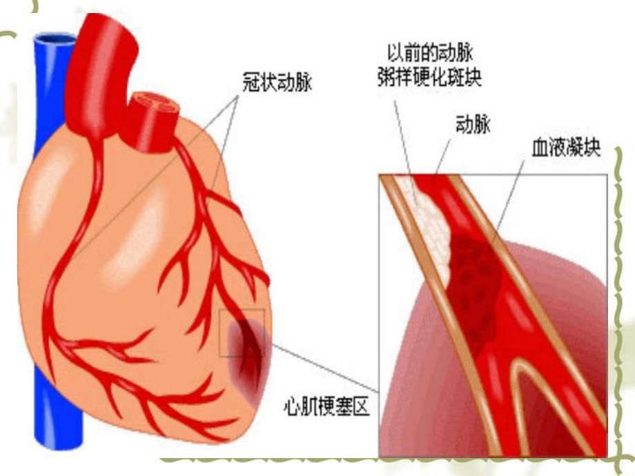 急性心肌梗死的急救护理PPT幻灯片.ppt_第2页