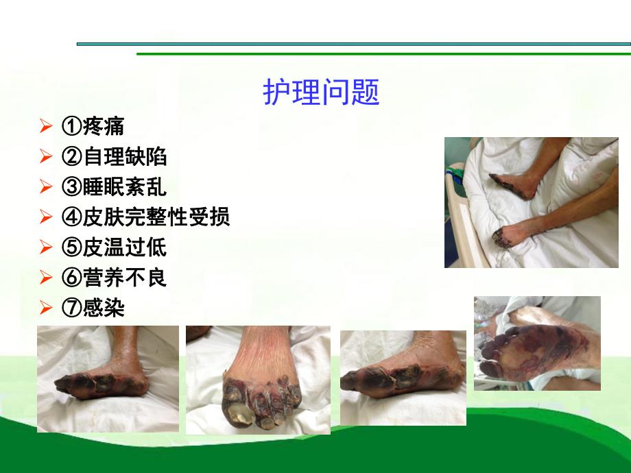 动脉血栓的护理查房.ppt_第3页