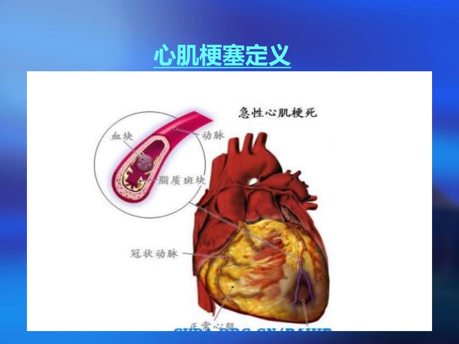 心肌梗塞护理查房.ppt_第3页