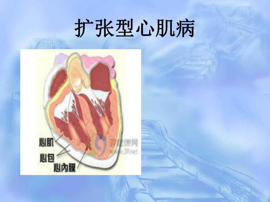 扩张型心肌病查房.ppt_第1页