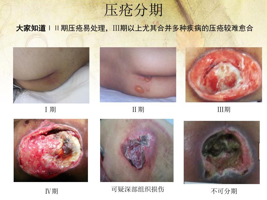 压疮个案护理查房.ppt_第2页