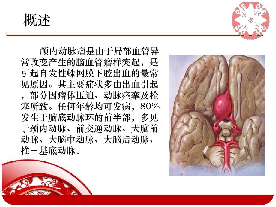 动脉瘤患者手术护理查房.ppt_第2页