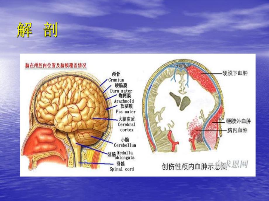 硬膜下血肿护理查房1.ppt_第3页