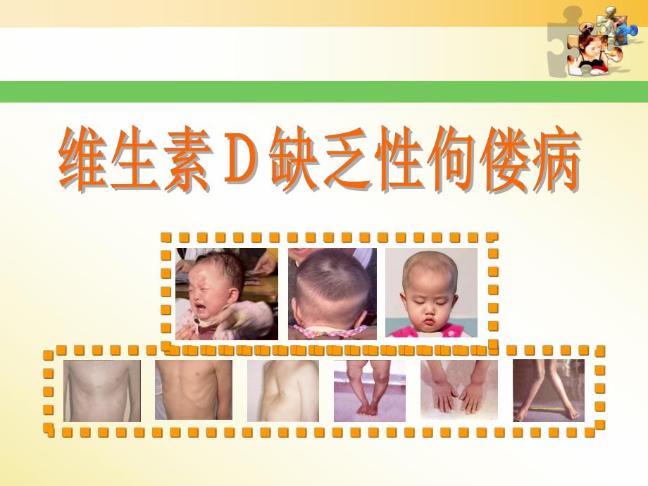 佝偻病患儿护理.ppt_第3页