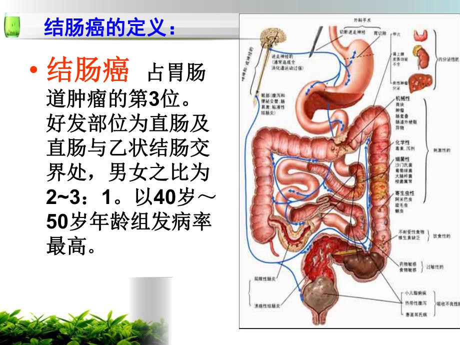 乙状结肠癌护理查房ppt.ppt_第2页