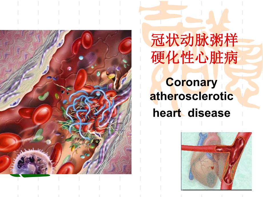 冠心病护理.ppt.ppt_第1页