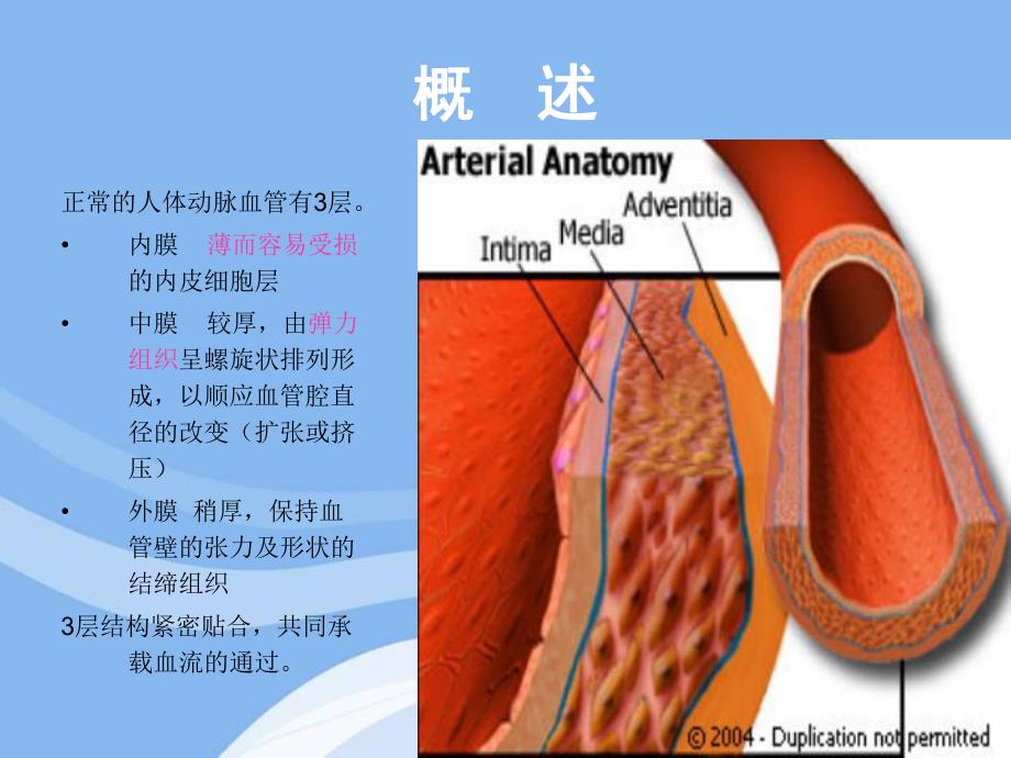 主动脉夹层患者的护理.ppt_第3页