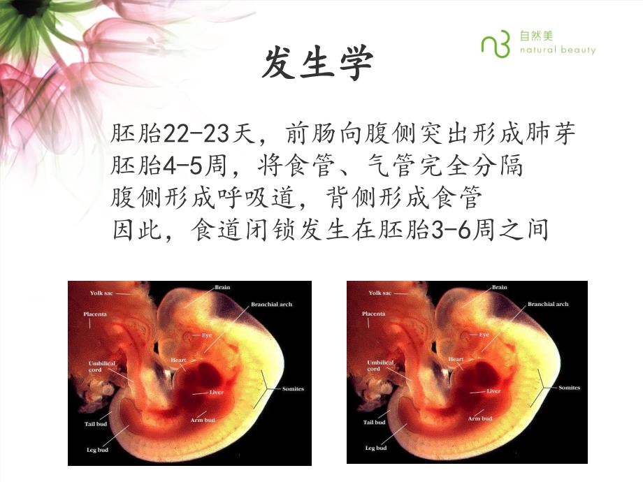 先天性食管闭锁的护理.ppt_第3页