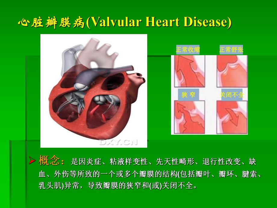 二尖瓣置换手术护理.ppt_第3页