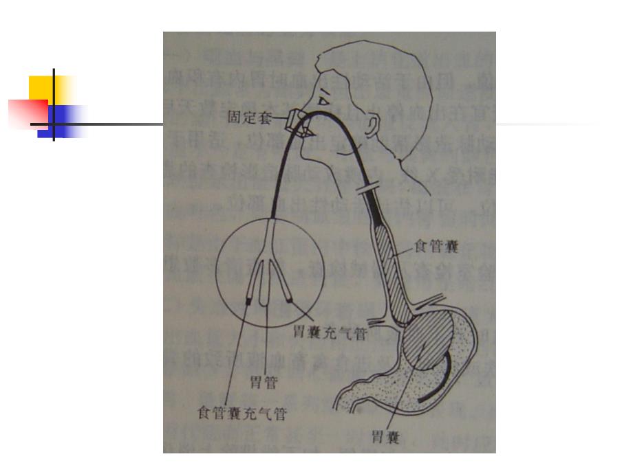 三腔二囊管的应用和护理精要.ppt_第3页