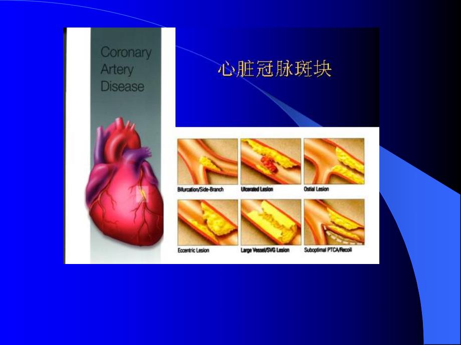 PCI护理医学幻灯片.ppt_第3页