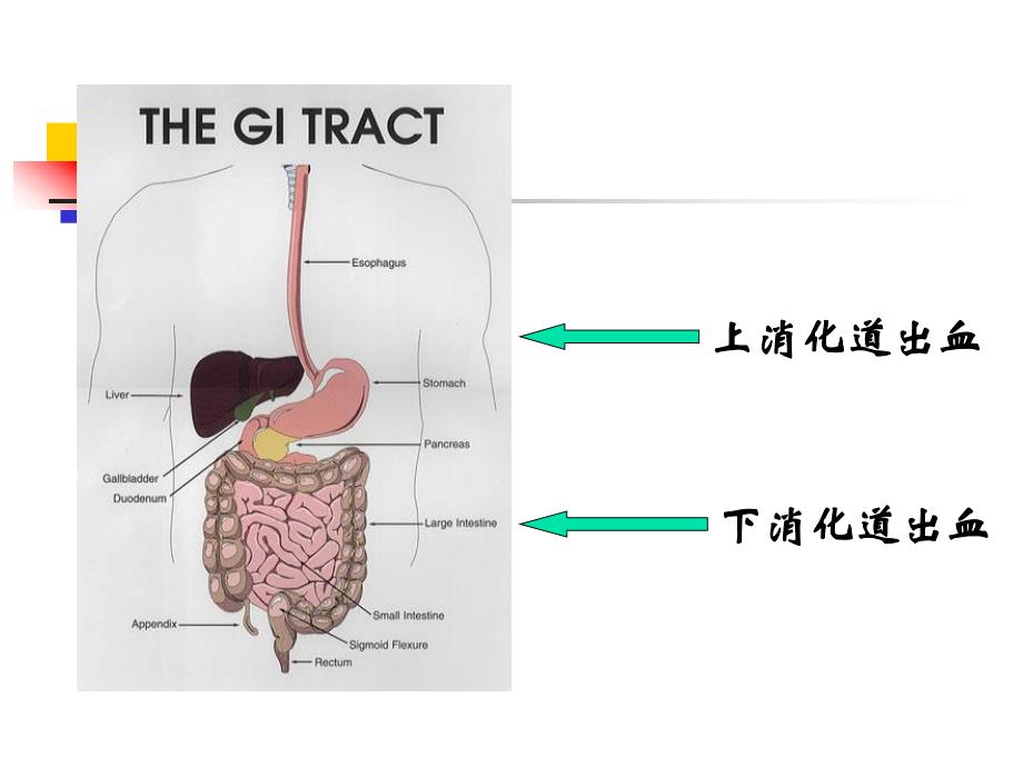 上消化道大出血病人的护理.ppt_第3页