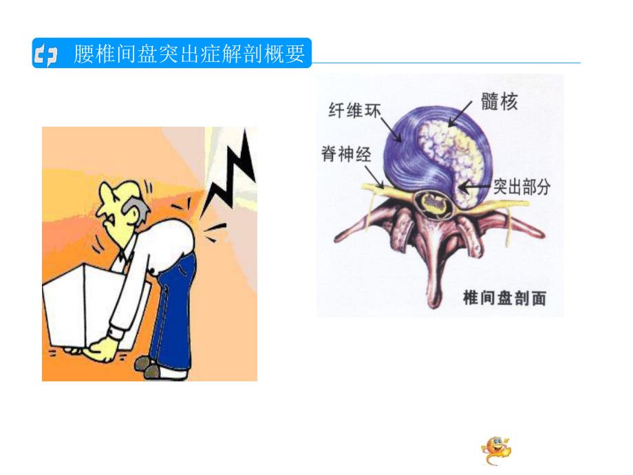 腰椎间盘突出的护理查房1.ppt_第3页