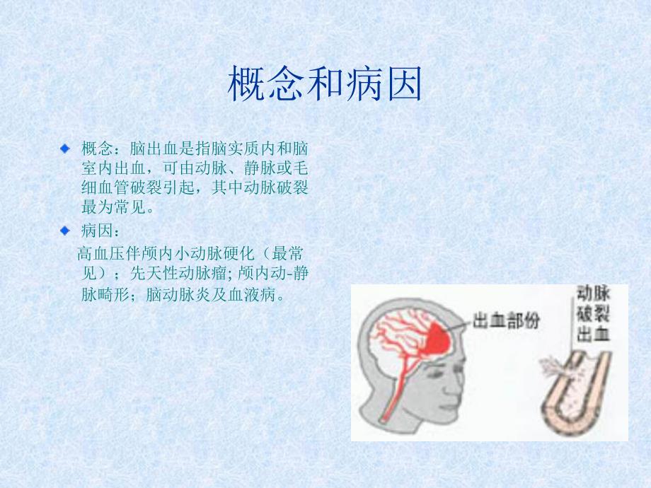 脑出血教学查房.ppt.ppt_第2页