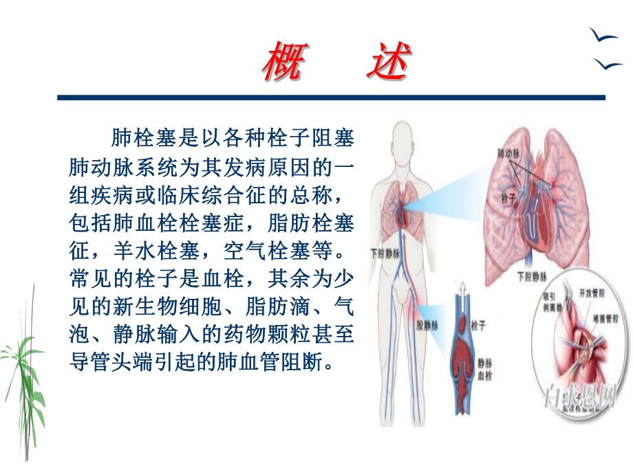 肺栓塞的治疗与护理.ppt_第2页