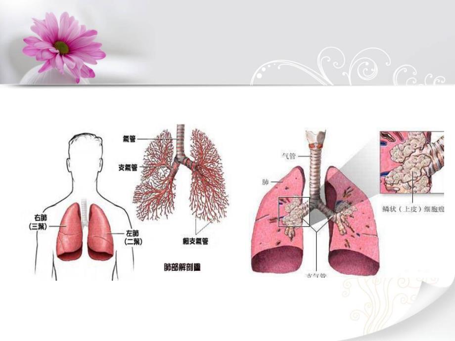 肺癌个案护理查房.ppt_第3页