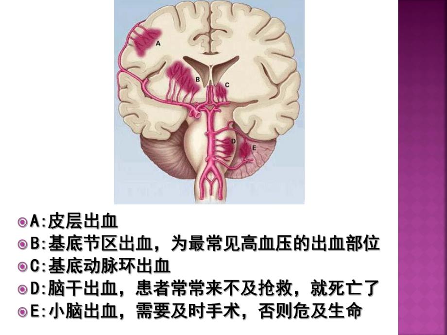 脑病科教学查房.ppt_第3页