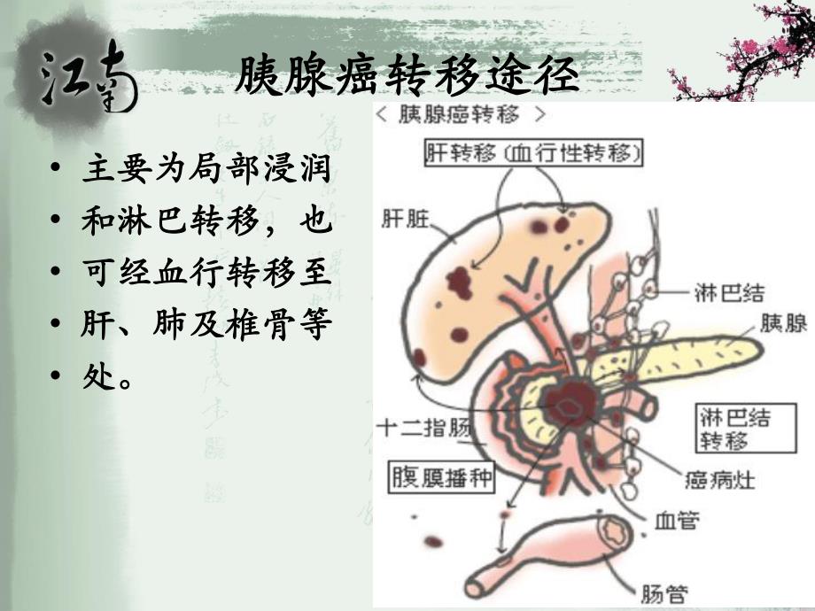 胰腺癌病人的护理.ppt_第3页