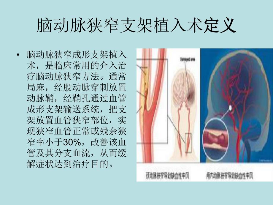 脑动脉狭窄支架植入术及护理.ppt_第3页