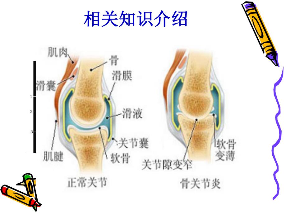 骨性关节炎病人的护理查房.ppt_第3页