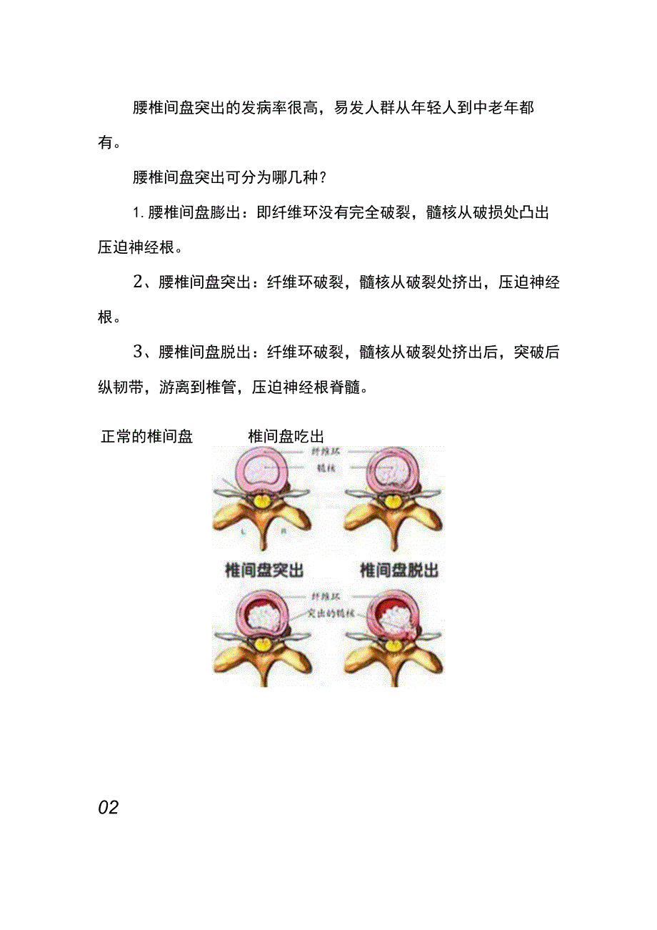 腰间盘突出康复锻炼的方法.docx_第2页