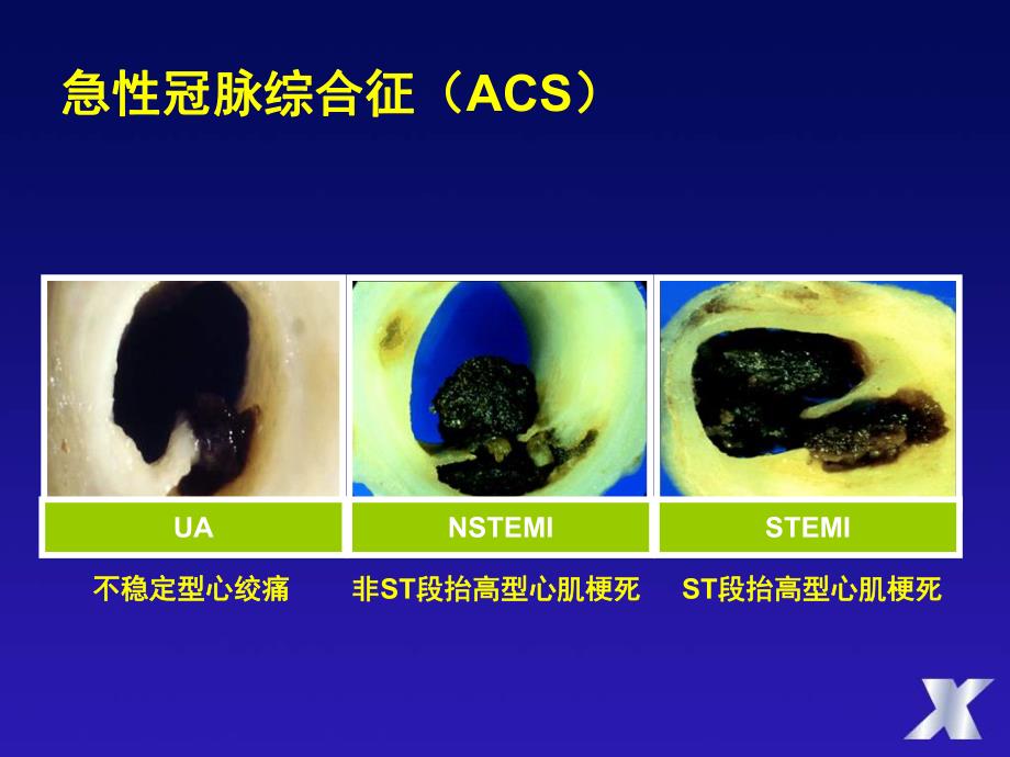 ACS抗凝治疗的风险与收益杨艳敏.ppt_第2页