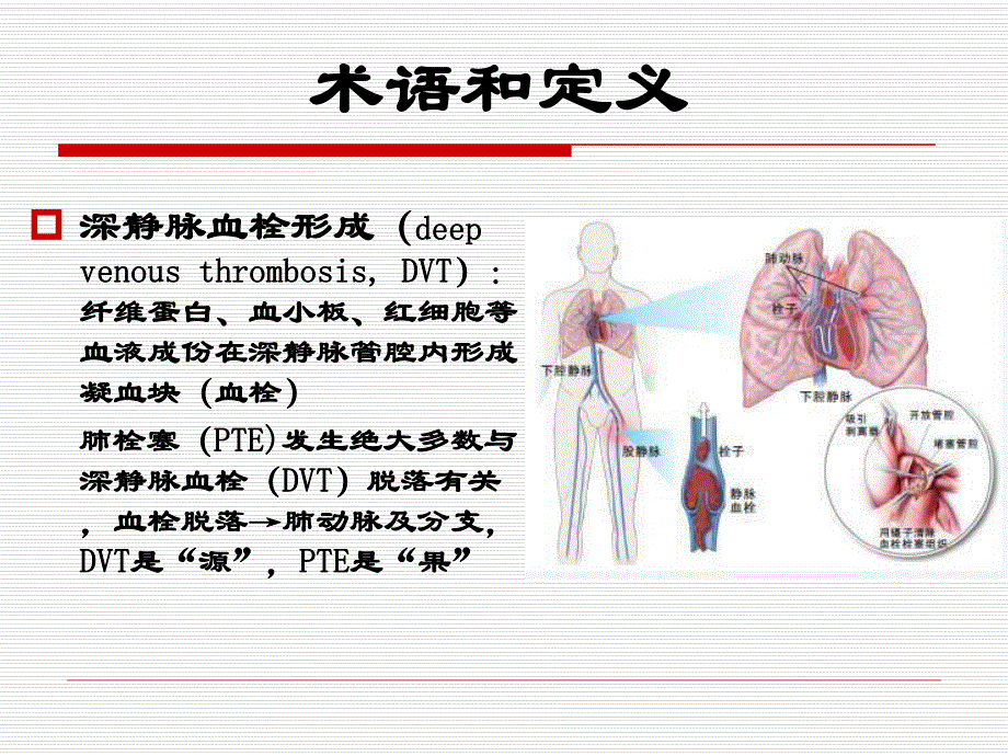 康复患者下肢静脉血栓防治.ppt_第2页