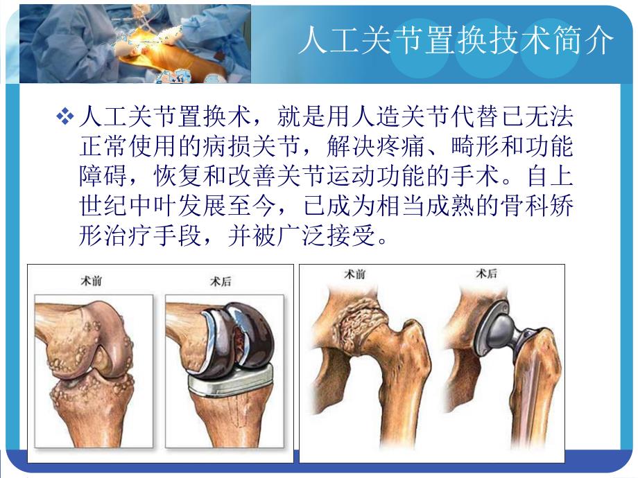 康复治疗在人工关节置换术治疗中的进展及发展方向.ppt.ppt_第2页